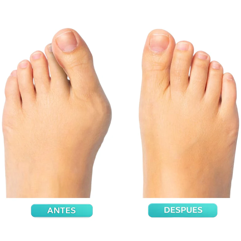 Toe Alignment Support & Bunion Relief Corrector